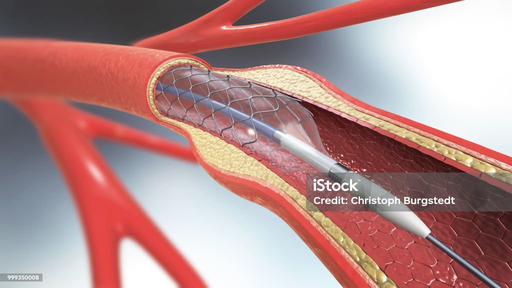 3d illustration of stent implantation for supporting blood circulation into blood vessels Catheter Stock Photo