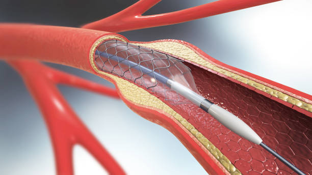 3d illustration of stent implantation for supporting blood circulation into blood vessels stock photo