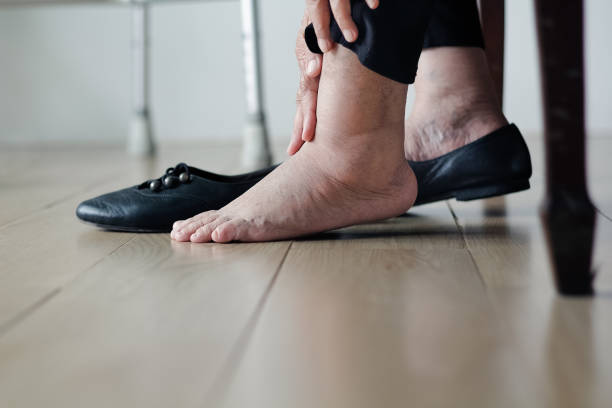 femme âgée, les mettre sur les chaussures de pieds enflée - jambe photos et images de collection