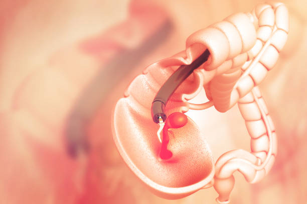 istock colon cancer. colonoscope in the colon. polyp removal 999970278