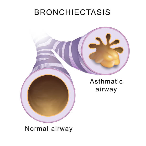 Bronchiectasis. Normal airway and asthmatic airway vector art illustration