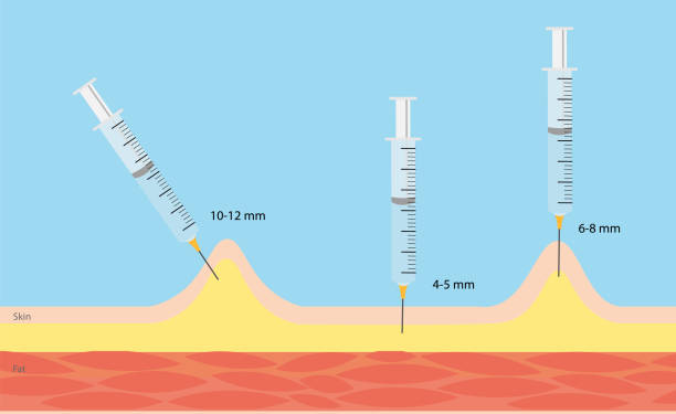 Insulin injection technique. Insulin injection technique. Syringe size and angle injection technique. diabetic foot stock illustrations
