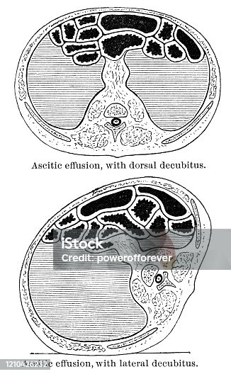 istock Medical Cross-section Diagram Showing Ascites in the Abdomen - 19th Century 1210426232