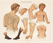 istock Skin diseases, chromolitograph, published in 1897 1006499732