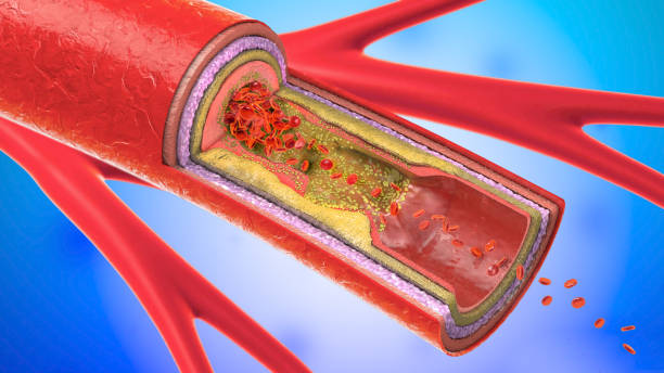 3d illustration of a precipitated and narrowing blood vessels or arteriosclerosis stock photo