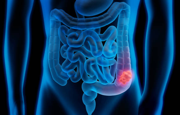 3d illustration of colon cancer - colon tumor Medical illustration of Colorectal Cancer - Polyp human digestive system photos stock pictures, royalty-free photos & images