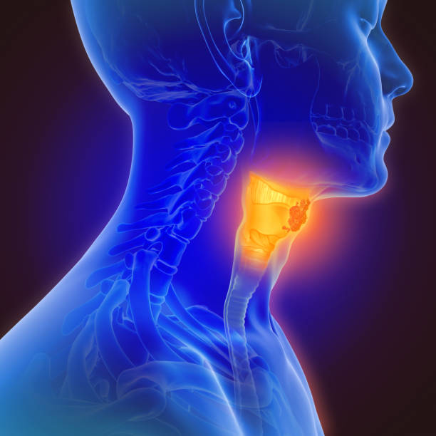 ilustración 3d del cáncer de garganta - cuello humano fotografías e imágenes de stock