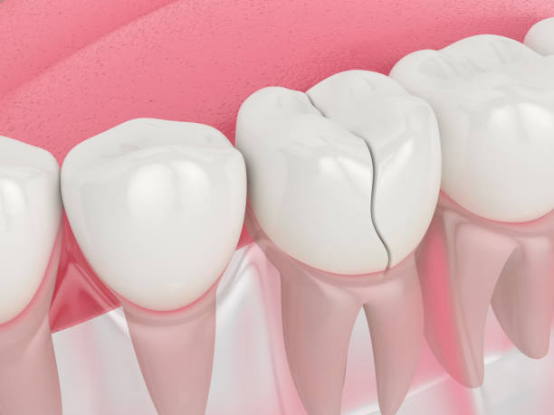 3d render of jaw with cracked tooth 3d render of jaw with treatable cracked tooth over white background. Types of broken teeth concept. peeling off stock pictures, royalty-free photos & images
