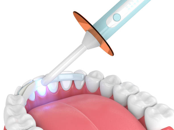 3d render des unterkiefers mit dental polymerisation lampe und dental-faser - freundschaftliche verbundenheit stock-fotos und bilder