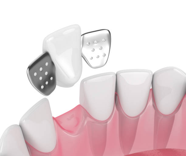 A resin-bonded bridge is sometimes called a Maryland bridge or a Rochette Bridge and tends to only be used to replace front teeth. This is because it is relatively fragile and is unable to withstand the chewing forces created by back teeth. It consists of two wings that are attached to the abutment teeth on the tooth surfaces nearest to the tongue, and the wings are attached to the replacement tooth or pontic.  The abutment teeth must be healthy and strong, but it's unlikely that your dentist will need to change their overall shape very much. Sometimes they may choose to remove a small amount of tooth enamel, As a slightly rougher surface will help increase the bond between the tooth and the bridge.  A rochette bridge has holes drilled into the wings to help increase this retention. It is a better solution than a removable denture, but it isn't as strong or as permanent as a fixed bridge and it will not function as well as implants.  Benefits  Resin-Bonded Bridge Cheaper and less invasive than a fixed bridge supported by your natural teeth. Restores your ability to smile and to eat and speak. Provides the correct amount of support for your lips. Prevents your remaining teeth from drifting out of place. Disadvantage  Resin-Bonded Bridge Isn't very strong, which is why it is only used to restore front teeth. Hard food can cause the bridge to pop off your teeth and need to be re-cemented. Relatively fragile which doesn't make it a good long-term option. When to choose a Resin-Bonded Bridge This option is cost-effective and non-invasive, particularly when compared to dental implants. It could be a good short-term solution and this type of bridge may occasionally be supplied as a temporary restoration, while an implant heals underneath the gums.