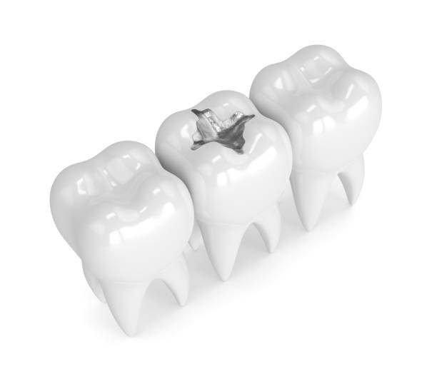 3d render of teeth with dental amalgam filling 3d render of teeth with dental amalgam filling over white background silver teeth stock pictures, royalty-free photos & images