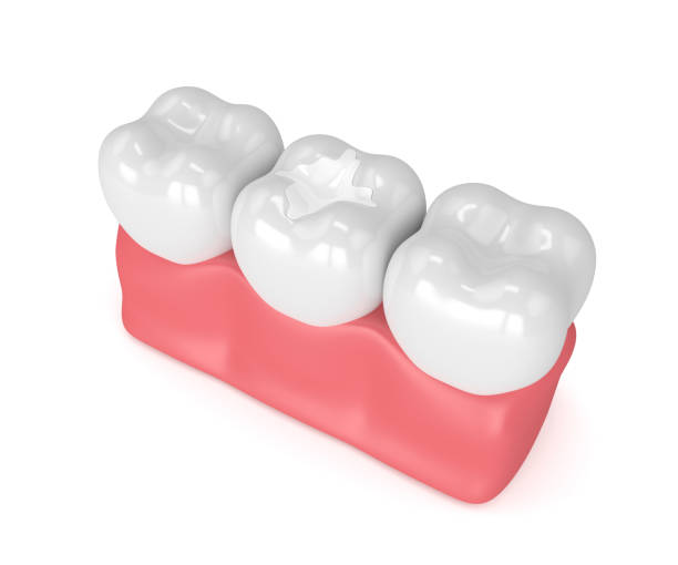 3d render of teeth with dental composite filling picture