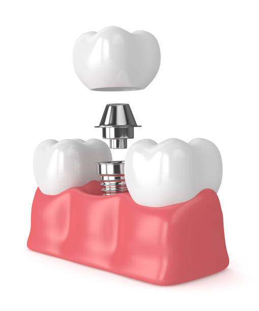 3d rendering der zähne mit zahnimplantaten - zahnimplantat stock-fotos und bilder