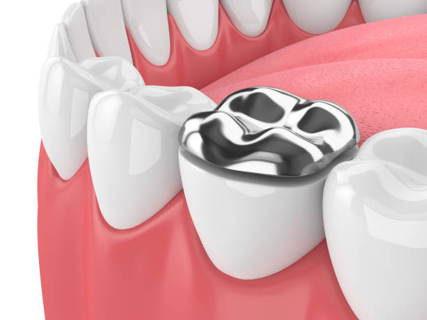 3d render of teeth with dental onlay amalgam filling 3d render of teeth with dental onlay amalgam filling over white background silver teeth stock pictures, royalty-free photos & images