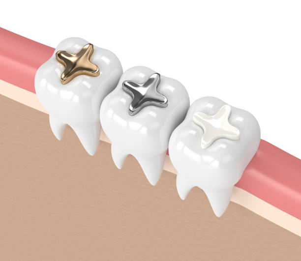 3d render of teeth with different types of dental filling 3d render of teeth with gold, amalgam and composite inlay dental filling in gums silver teeth stock pictures, royalty-free photos & images