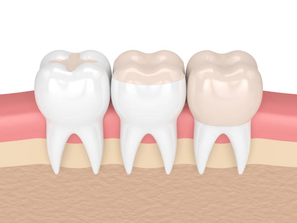 3d render of teeth with different types of filling 3d render of teeth with inlay, onlay and crown filling in gums dental cavity stock pictures, royalty-free photos & images