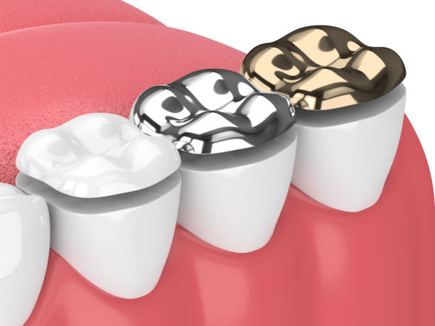 3d render of teeth with onlay 3d render of jaw with teeth and three types of onlay over white silver teeth stock pictures, royalty-free photos & images