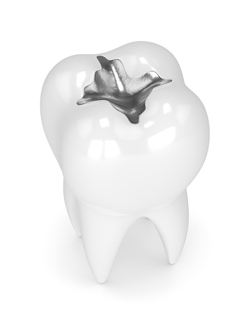 3d render of tooth with dental amalgam filling over white background