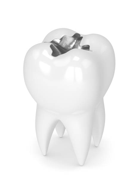3d render of tooth with dental amalgam filling 3d render of tooth with dental amalgam filling over white background silver teeth stock pictures, royalty-free photos & images