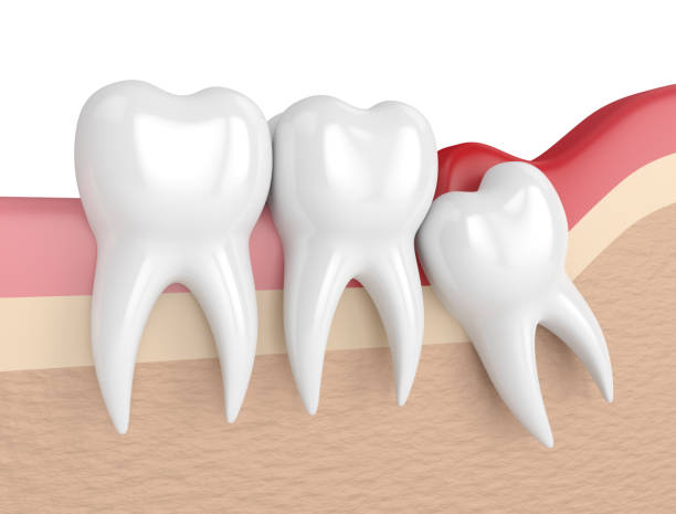 3d render of  wisdom mesial impaction with pericoronitis 3d render of  wisdom mesial impaction with pericoronitis. Concept of different types of wisdom teeth problems. wisdom stock pictures, royalty-free photos & images