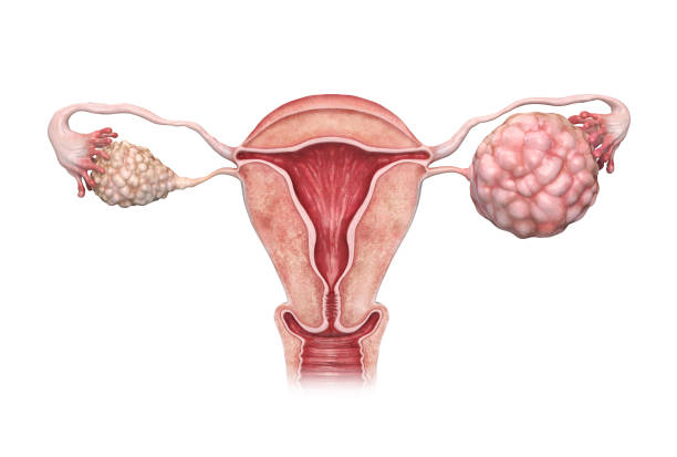 3d rendered ovarian cancer illustration. stock photo