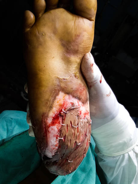 a perforated skin graft in a diabetic foot by plastic surgery a perforated skin graft in a diabetic foot by plastic surgery diabetic foot stock pictures, royalty-free photos & images