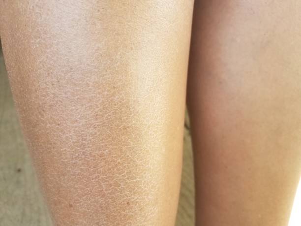 a woman's dry flaky itchy legs stock photo