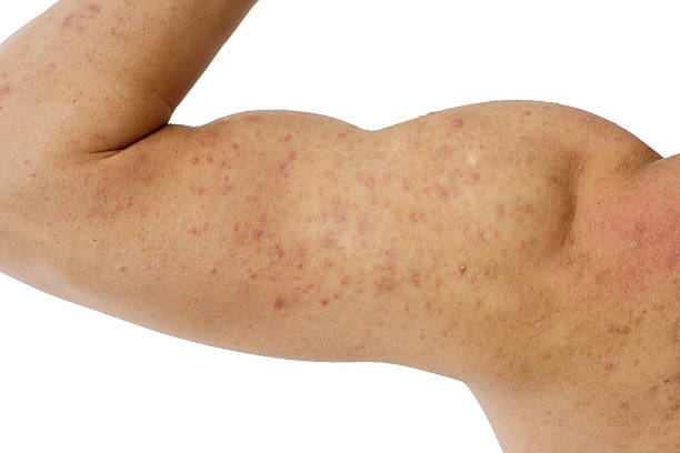 Royalty Free Body Acne Pictures, Images and Stock Photos - iStock