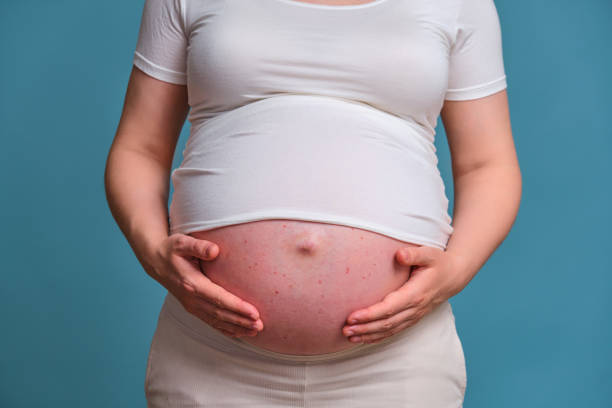 Acne on the stomach of a pregnant woman, studio photo on a blue background Acne on the stomach of a pregnant woman, studio photo on a blue background pregnancy acne stock pictures, royalty-free photos & images