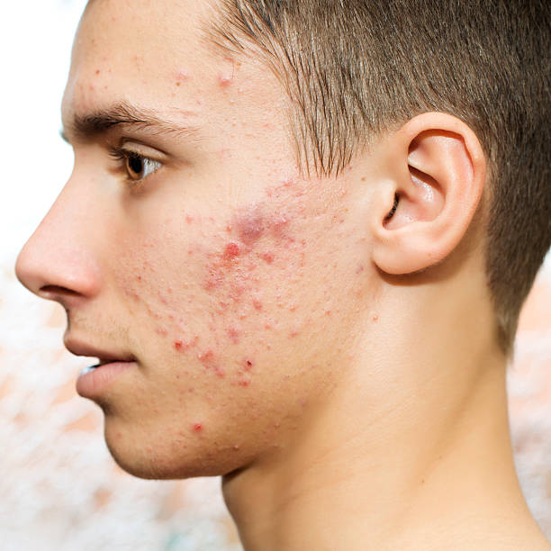 Acne Puberty age and pimples. Male with acne skin acne on men stock pictures, royalty-free photos & images