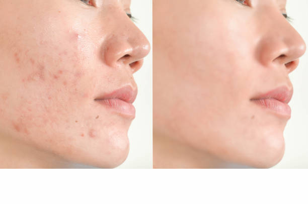 acne littekens en poriën. zwarte vlekken, rimpels en huidproblemen - verwachting stockfoto's en -beelden