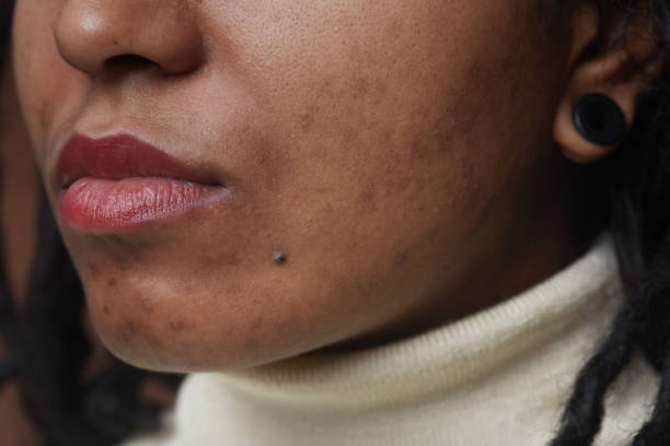 Acne Scars Close Up Extreme close up portrait of real African American woman with post acne spots and skin imperfections imperfection stock pictures, royalty-free photos & images