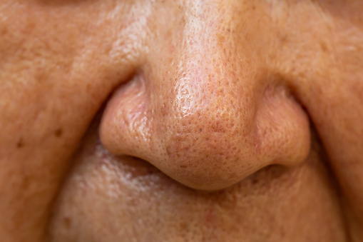 Acne Small Pimple Is On Senior Womans Nose Deep Groove Cheeks