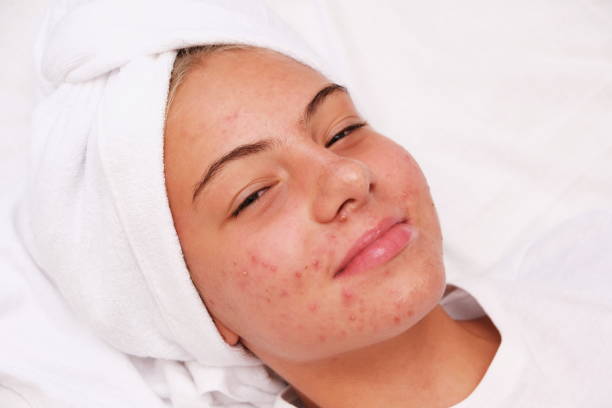 Acne. smiling teenage girl with pimples on her face. Facial skin care. Acne. A smiling teenage girl with pimples on her face. Facial skin care. Problematic skin in adolescents. acne stock pictures, royalty-free photos & images