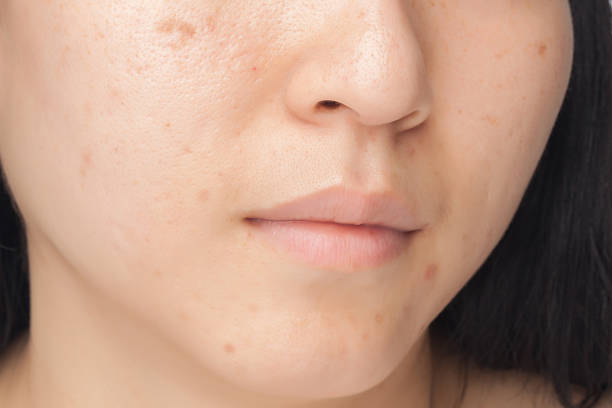 Acne spots stock photo