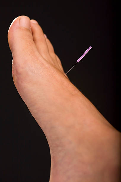 Acupuncture foot stock photo