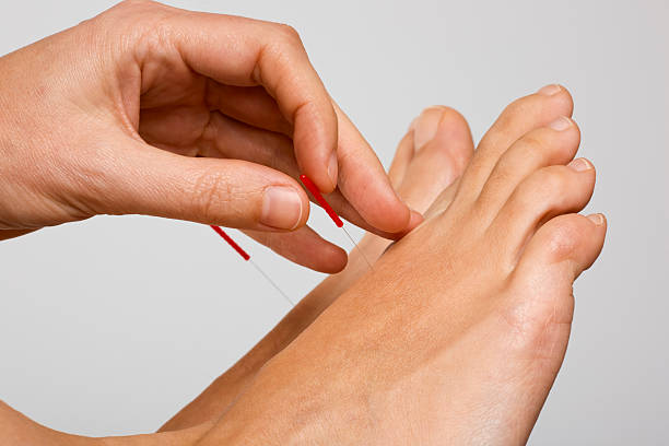 Acupuncture needle applied to foot stock photo