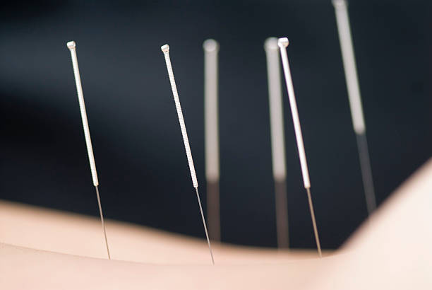 Acupuncture needles placed in someone's skin stock photo