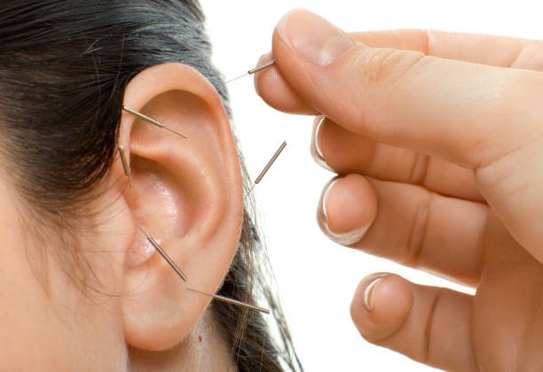 acupuncture acupuncture therapy on auricle, horizontal very close up photo acupuncture stock pictures, royalty-free photos & images