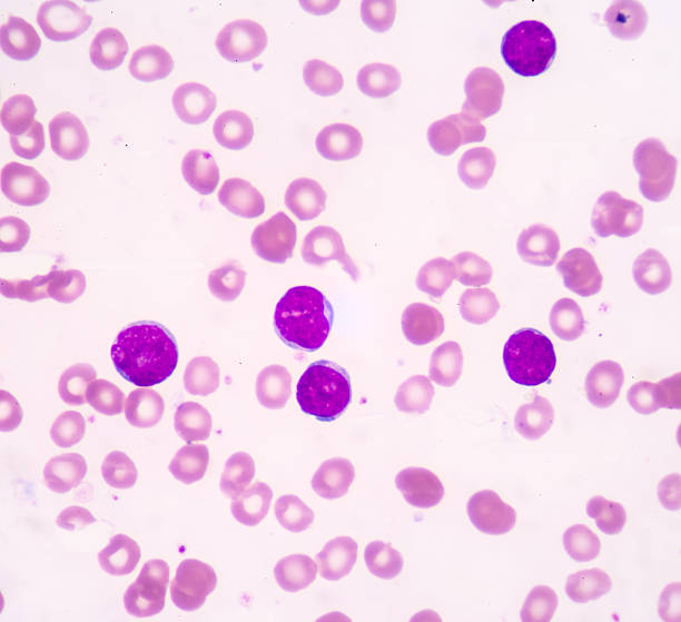 Acute lymphoblastic leukemia(ALL) Blood cell formation from bone marrow.Acute lymphoblastic leukemia(ALL),fine with microscope(100x) acute angle stock pictures, royalty-free photos & images