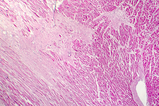 Acute Myocardial Infarction Histology Of Heart Tissue Light Micrograph ...