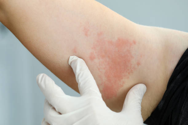 inspección de las fiebres alérgicas - enfermedad de la piel fotografías e imágenes de stock