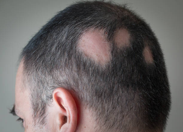 alopecia aerata - plek kaalheid - haaruitval stockfoto's en -beelden