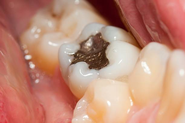 Amalgam filling Macro of a tooth with amalgam filling alloy stock pictures, royalty-free photos & images