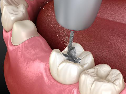 Amalgam removing and preparation for ceramic crown placement. 3D illustration of dental concept
