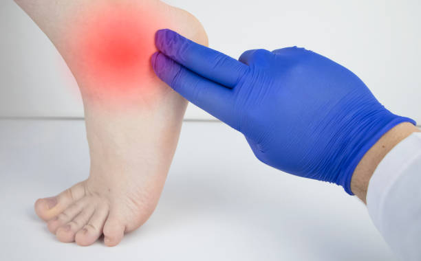 An orthopedic doctor examines a woman's leg. Heel pain, tendon stretching, inflammation, heel spur. Foot Disease Treatment Concept Foot Disease Treatment Concept. An orthopedic doctor examines a woman's leg. Heel pain, tendon stretching, inflammation, heel spur. plantar fasciitis stock pictures, royalty-free photos & images
