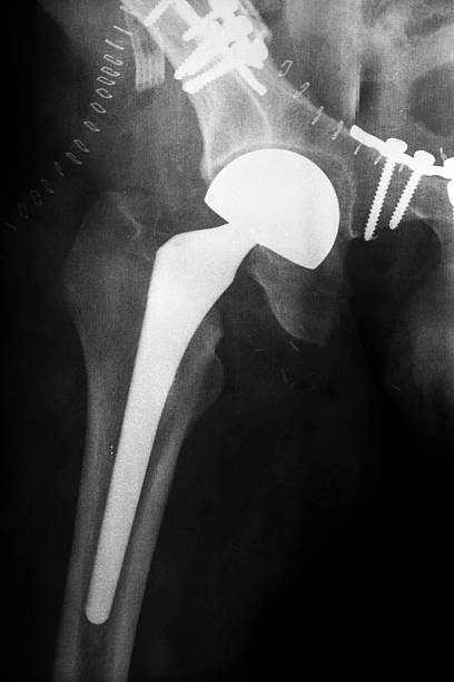 Artificial hip joint and pelvic reconstruction Postsurgical x-ray image shows an artificial hip joint and pelvic reconstruction with plates and screws. x ray plates stock pictures, royalty-free photos & images