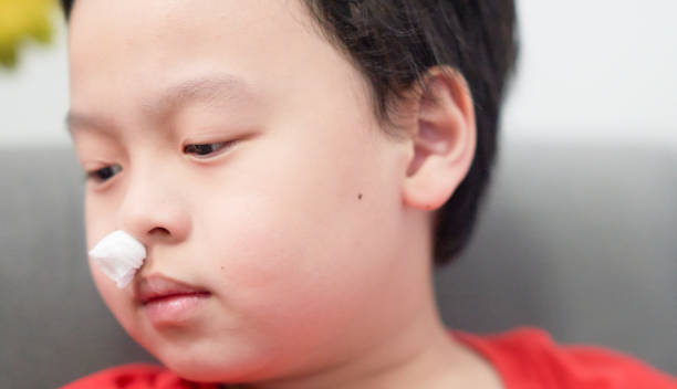 asian little boy nosebleed with gauze pack to stop epistaxis stock photo