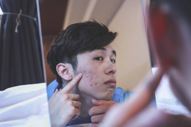 Asian man got an Acne Asian man doing skin care for Acne skin acne on men stock pictures, royalty-free photos & images