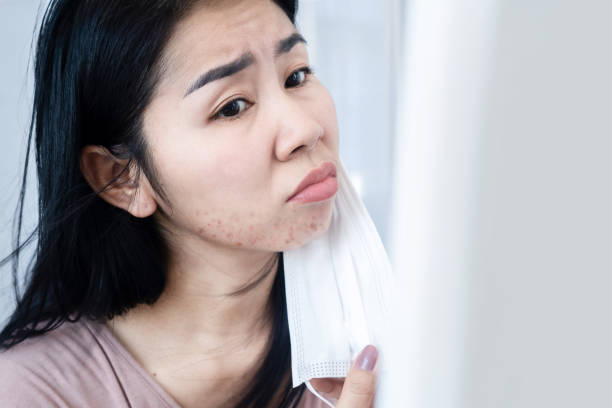 Asian woman having acne and rash skin allergy under chin and face because of protective mask stock photo